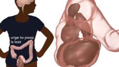 سلس البراز: 11 سبب 19 أسباب سلس البراز