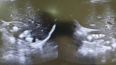 تكلس الكلى: 4 أعراض 21 أعراض تكلس الكلى