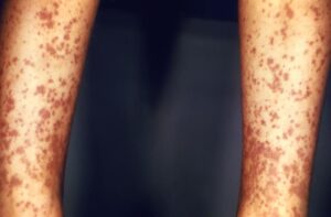 أعراض التهاب الأوعية بالغلوبيولين المناعي A هينوخ شونلاين