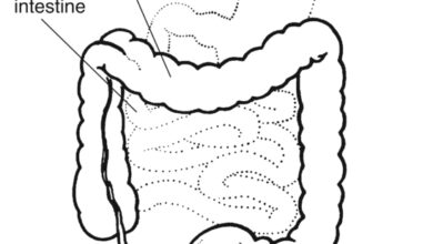 التهاب القولون المجهري: 7 أعراض 24 أعراض التهاب القولون المجهري والليمفاوي والكولاجيني