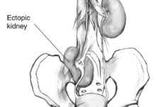 اعراض الكلية المهاجرة أو الساقطة أو المنتبذة