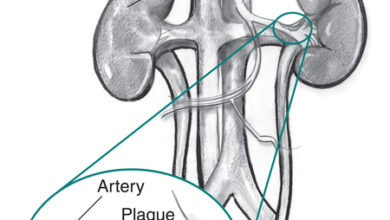اعراض تضيق الشريان الكلوي