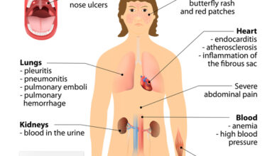 التهاب الكلى الذئبي: 3 أعراض 17 اعراض التهاب الكلى الذئبي