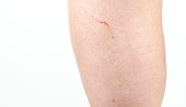 المتلازمة الكلوية عند الكبار: 5 أعراض 31 اعراض المتلازمة الكلوية عند الكبار