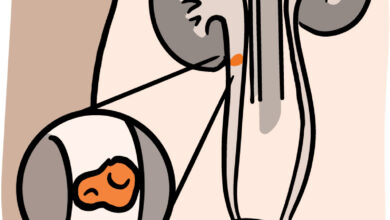 حصوة الكلية والمثانة عند الطفل: 4 أنواع 19 أعراض حصى الكلى عند الأطفال