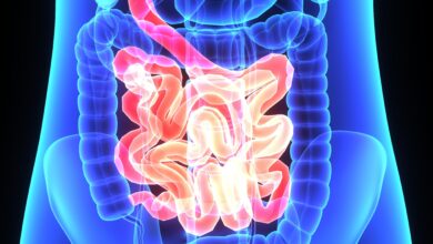 متلازمة الأمعاء القصيرة: 9 أعراض 16 أعراض متلازمة الأمعاء القصيرة
