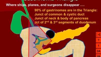 متلازمة زولينجر اليسون: 10 أعراض 25 اعراض متلازمة زولينجر اليسون