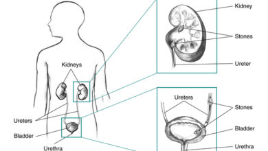 طعام حمية مرضى حصى الكلى