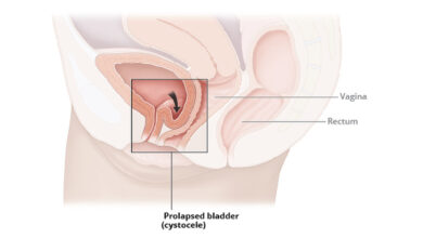 أسباب هبوط المثانة