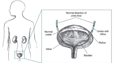 الارتجاع البولي عند الأطفال: 5 درجات 18 درجات الارتجاع البولي عند الأطفال