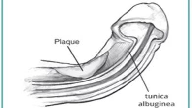 مرض بيروني: 3 أسباب 19 أعراض مرض بيروني