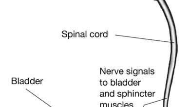 حصر و احتباس البول