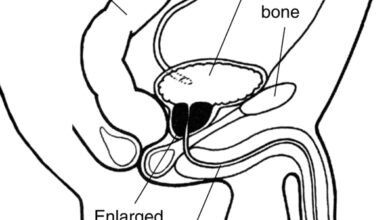 تضخم البروستاتا الحميد: 10 أعراض 17 تضخم البروستات الحميد