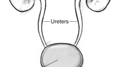 التهاب حوض الكلى للكبار