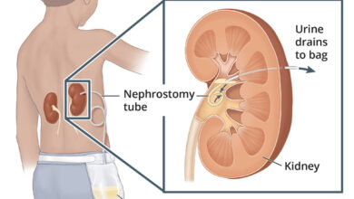 عملية تغيير مسار البول عند الأطفال: 6 أنواع 16 ما هي عملية تحويل مسار البول