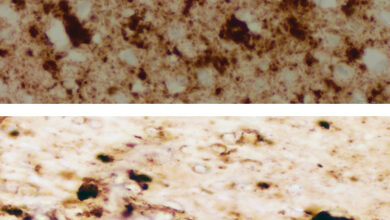 هل العلاج بهرمون النمو يسبب مرض كروتزفيلد جاكوب؟ 17 العلاج بهرمون النمو ومرض كروتزفيلد جاكوب؟