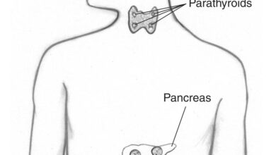 مرض الورم الصماوي المتعدد MEN 1 14 مرض الورم الصماوي المتعدد MEN 1