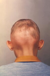 التهاب الغدد العرقية القيحي: 3 أعراض 15 سبب تساقط الشعر