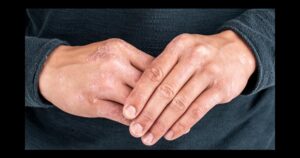 الصدفية: 4 أنواع 15 ادوية معالجة الصدفية