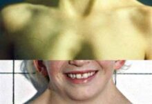 أعراض وعلامات متلازمة تيرنر