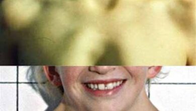 بالصور: 14 هي أعراض متلازمة تيرنر 20 أعراض وعلامات متلازمة تيرنر