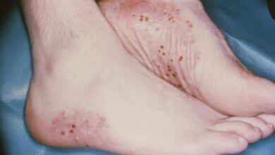 التهاب الجلد التأتبي: 4 أعراض 15 التهاب الجلد التأتبي عند الأطفال