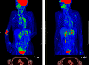 ألم العضلات الروماتيزمي والتهاب الشرايين ذو الخلايا العملاقة: 8 أعراض 20 ألم العضلات الروماتيزمي والتهاب الشرايين ذو الخلايا العملاقة