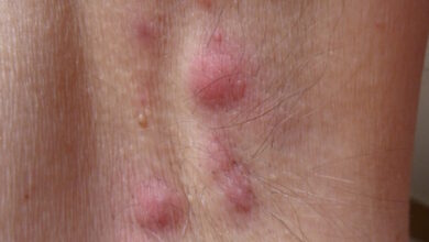 التهاب الغدد العرقية القيحي: 3 أعراض 22 أسباب التهاب الغدد العرقية القيحي