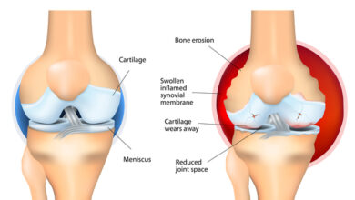 التهاب المفاصل الروماتويدي عند الأطفال: 7 أنواع 19 انواع التهاب المفاصل الروماتويدي عند الأطفال