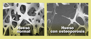 هشاشة العظام عند الرجال: 7 أسباب 15 الفرق بين العظام الطبيعية وهشاشة العظام