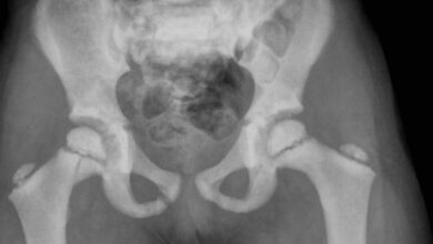 تصخر العظام: 7 أعراض 17 أسباب تصخر العظام