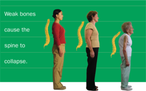 تضيق العمود الفقري: 5 أعراض 1