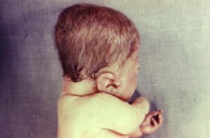 مرض تكون العظم الناقص: 7 أعراض 14 تكون العظم الناقص