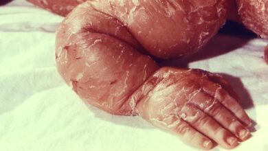 مرض السماك الجلدي: 30 نوع 22 أسباب مرض السماك الجلدي