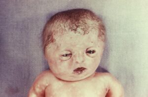 مرض تكون العظم الناقص: 7 أعراض 13 أسباب مرض العظم الزجاجي