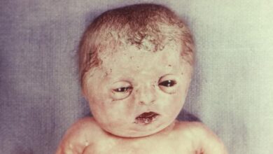 مرض العظم الزجاجي: 7 أعراض 18 أسباب مرض العظم الزجاجي