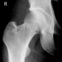 تنخر العظام