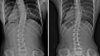 الجنف عند الأطفال والمراهقين: 5 أعراض 22 اسباب الجنف عند الأطفال والمراهقين