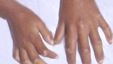 أعراض التصلب المجموعي