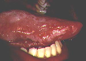 سرطان الفم: 10 أعراض 13 الطلاء الأبيض