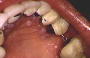 سرطان الفم: 10 أعراض 14 ثآليل الفم