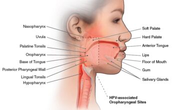 سرطان الفم: 10 أعراض 18 علاج سرطان الفم