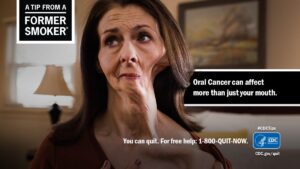 سرطان الفم: 10 أعراض 15 عملية سرطان الفم