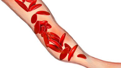 تكسر الدم: 6 أسباب 20 تكسر وانحلال الدم