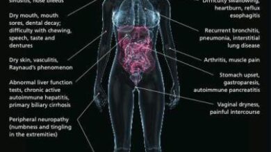 مرض شوغرن: 7 نصائح 17 مرض شوغرن: 7 نصائح