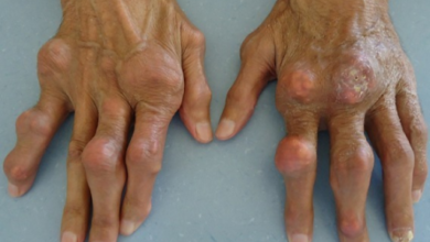 ارتفاع اليوريك أسيد في الدم: 3 أعراض 15 ارتفاع اليوريك أسيد