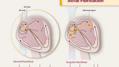 الرجفان الاذيني