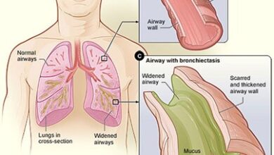 توسع القصبات الهوائية: 5 أسباب 21 أنواع توسع القصبات الهوائية