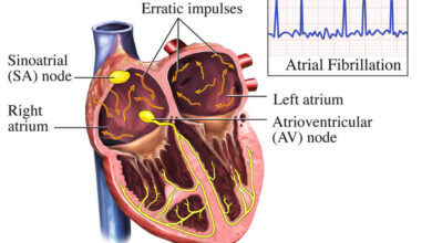 اللانظميات القلبية: 9 أعراض 21 رجفان اذيني