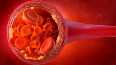 ارتفاع الكولسترول: 3 أعراض 21 ارتفاع الكولسترول